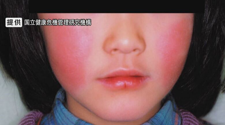 「りんご病」感染が急拡大　患者は過去10年で最多　子どもがかかりやすく頬が赤くなり全身に痒みを伴う発疹が　長野県「流行が続く可能性が高い」｜FNNプライムオンライン