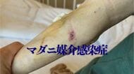 「ちょっと変やな」から診断まで1週間　マダニ媒介感染症に注意　致死率10～30％のSFTSが全国的に増加傾向