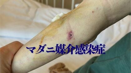 「ちょっと変やな」から診断まで1週間　マダニ媒介感染症に注意　致死率10～30％のSFTSが全国的に増加傾向