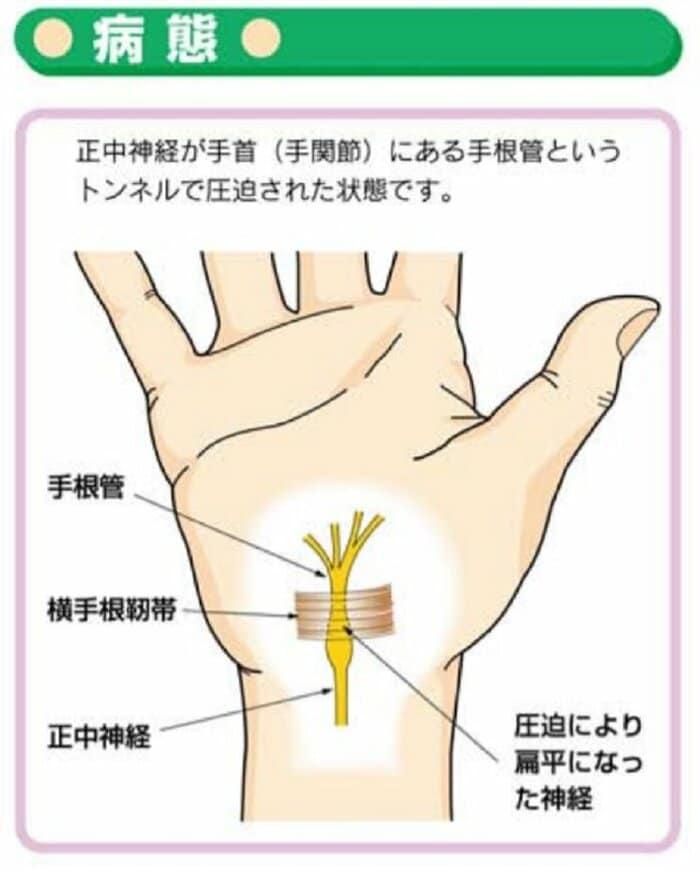 手根管症候群 病態(画像提供:日本整形外科学会)