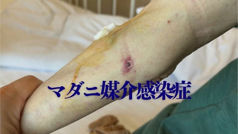 「ちょっと変やな」から診断まで1週間 マダニ媒介感染症に注意 致死率10~30%のSFTSが全国的に増加傾向|FNNプライムオンライン