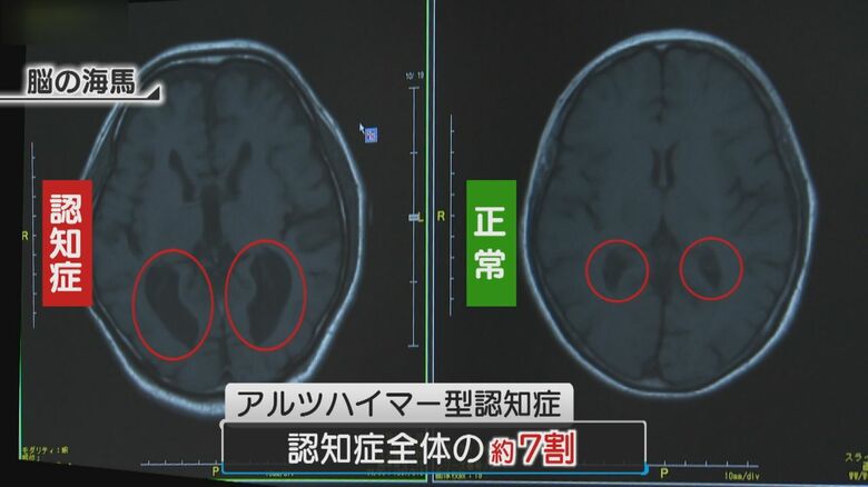 アルツハイマー型認知症
