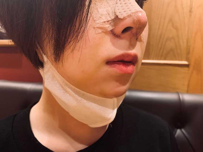 取材に応じた女性の顔には、生々しい手術痕が残る