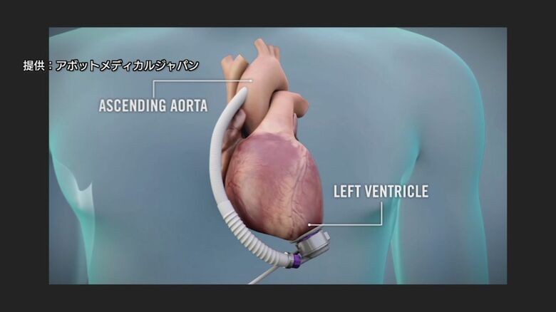 補助人工心臓イメージCG