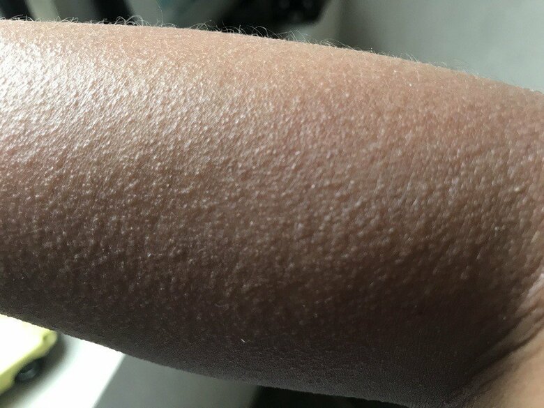 光線過敏症の症例（2017年撮影）