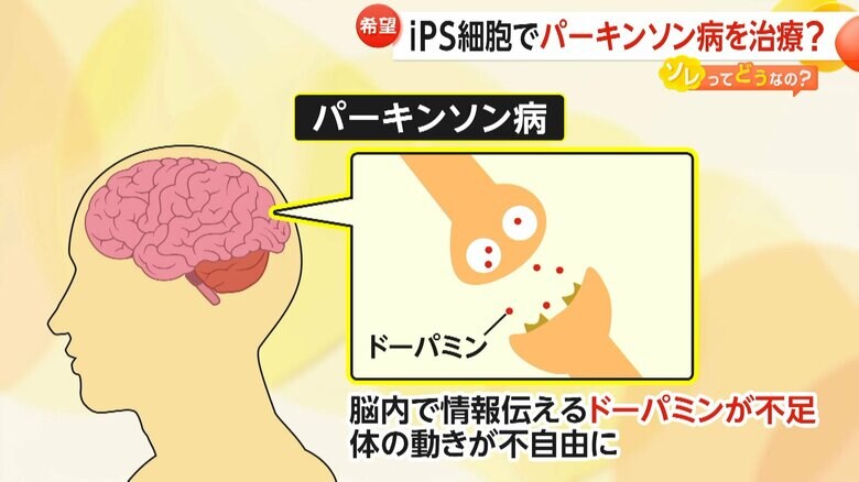 脳内で情報を伝えるドーパミンが不足することで起きるパーキンソン病
