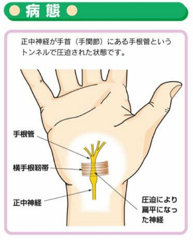 手根管症候群　病態（画像提供：日本整形外科学会）