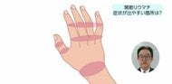 関節に痛みや腫れを感じたら「血液検査」 リウマチの初期症状と早期治療の重要性について名医が解説