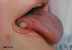舌の側面が白くなったら注意　「舌がん」は若年層や女性に増加傾向　命を守る10のセルフチェック【医師監修】