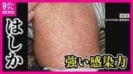 「はしか」感染が相次ぐ　妊婦と乳幼児は特に注意　最大の予防策はワクチン　接種歴が不明の場合『抗体検査』　【専門家解説】