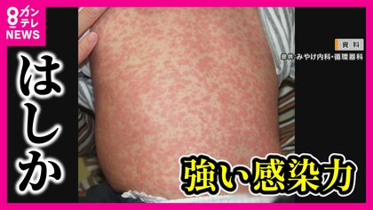 「はしか」感染が相次ぐ　妊婦と乳幼児は特に注意　最大の予防策はワクチン　接種歴が不明の場合『抗体検査』　【専門家解説】
