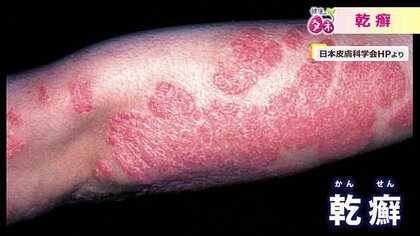 “見た目”を気にし、うつ病発症も…慢性の皮膚疾患「乾癬」は“オーダーメイド治療”が可能に「一人で悩まず受診を」