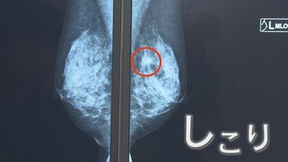 「乳がん検診受けていますか？」　検診で早期発見の重要性を『ピンクリボン月間』に考える