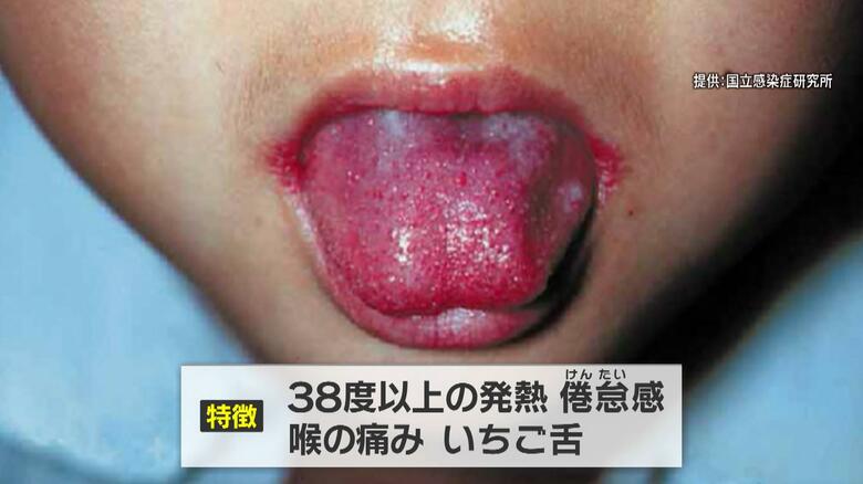 溶連菌感染症の症状