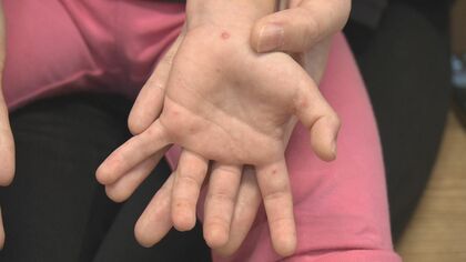 具体的な症状や発熱等は…『手足口病』とはこんな病気 飛沫や接触によって主に“5歳以下”の子供が感染