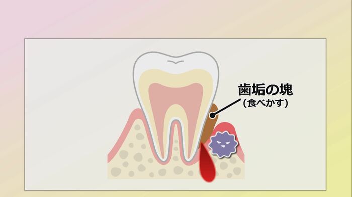 血液中のヘミン鉄を歯周病菌が取り込み…