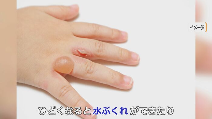 皮膚が薄い子供は水ぶくれになることも