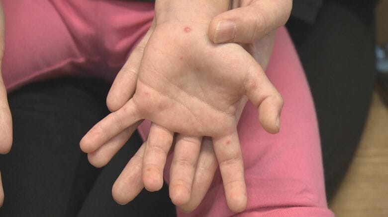 具体的な症状や発熱等は…『手足口病』とはこんな病気 飛沫や接触によって主に“5歳以下”の子供が感染｜FNNプライムオンライン