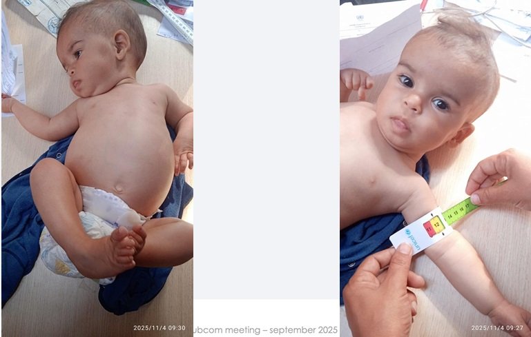 11月になっても上腕の外周は12.1cm（UNRWA提供）