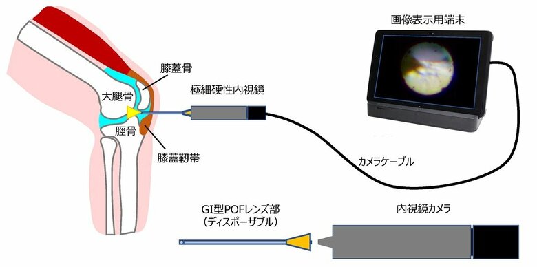 極細硬性内視鏡による膝関節内検査イメージ（画像提供：慶應義塾大学　小池康博教授）