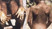 欧米で「サル痘」感染例相次ぐ…WHO状況を注視