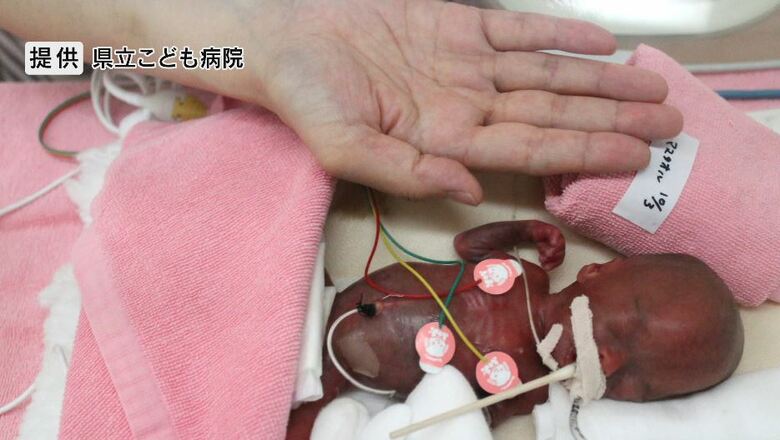 生まれた時の竜佑ちゃん　（提供：長野県立こども病院）