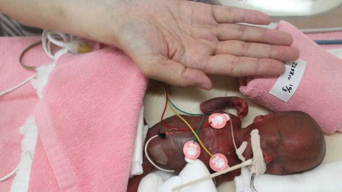体重258グラム、身長22センチで生まれる 提供:長野県立こども病院