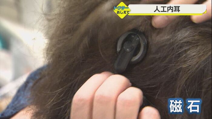 人工内耳の外部分を見せる小堀さん