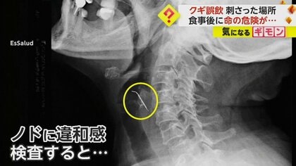 「てっきり骨だろうと」喉から約5cmの釘を摘出　誤飲して頸動脈を貫通…その状態で1カ月過ごすも無事退院　ペルー