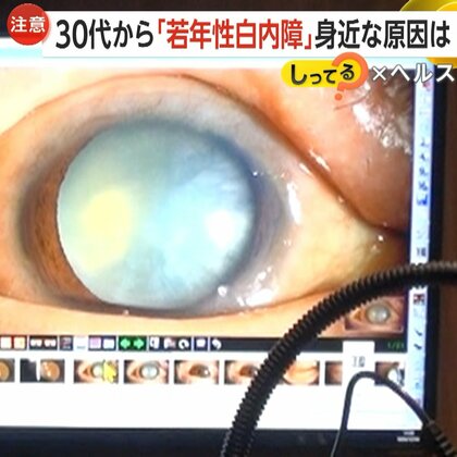 【増加する若年性白内障】ドランクドラゴン・塚地武雅さん（53）も公表　PC・スマホ長時間使用も原因に…失明リスクも「眩しさ感じたら要注意」【しってる？】