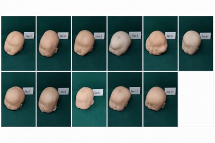 「ただのゆがみ」か「手術が必要な病気」か、頭のかたちに関する医師の判別正答率はわずか14.1％。慶應義塾大学医学部 形成外科学教室 坂本専任講師の研究が視診触診による頭の診断の限界を可視化
