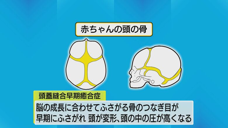 赤ちゃん特有の頭蓋骨