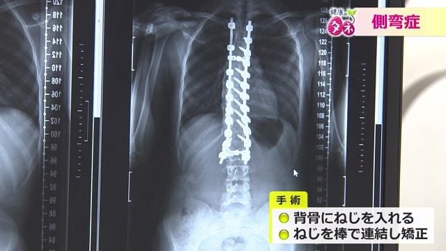 ねじで固定する側弯症の治療