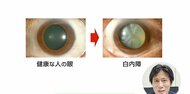 “白内障”を放置すると認知症リスクが約3倍に 最新の治療法と眼の健康を維持する方法を専門医が解説