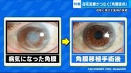 看取りの時に「角膜」提供しませんか…失明の不安に希望の光を　“角膜提供”へ在宅医療医師の取り組み【広島発】