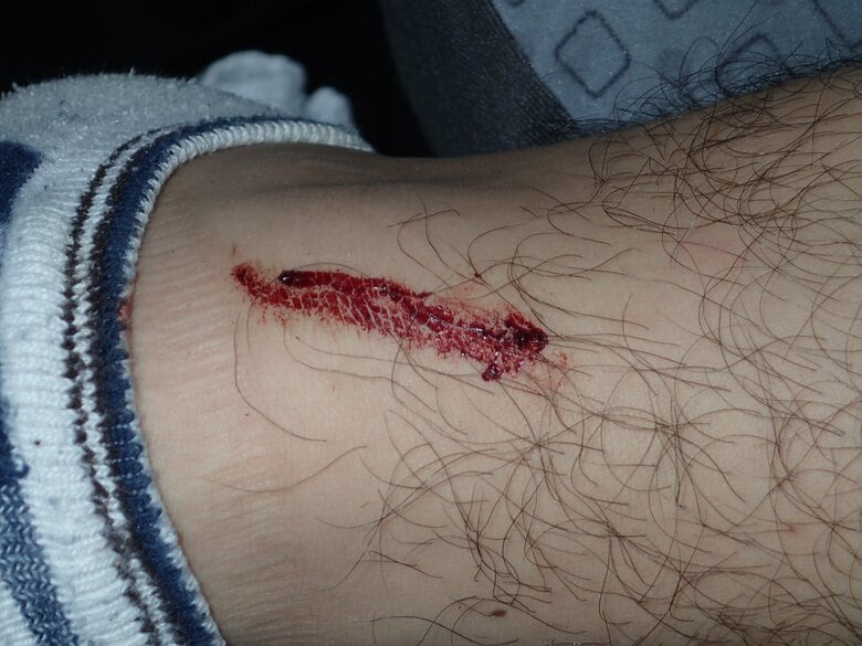 血が止まりにくくなることも（画像提供：西海太介さん）