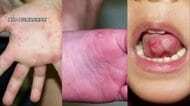 「手足口病」が急増　2歳以下の感染が9割　手や足、口の中に水疱性の発疹　子どもを中心に流行する夏の感染症に注意