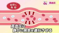 あるとき突然！脳卒中や心筋梗塞が…　静かに病気が進行するサイレントキラー「高血圧」　自分の血圧を知り塩分は控えめに　福井