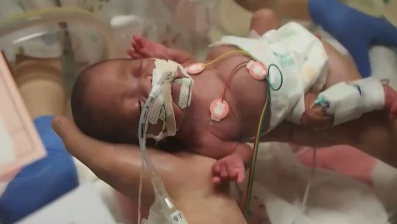 予定より4カ月早い妊娠24週で生まれ、体重664グラム（提供：高橋さん）