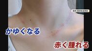 「安物ほど危険」医師が警鐘　汗ばむ季節はリスク高い金属アレルギー…夏場にピアス穴を開けるのもNG行動