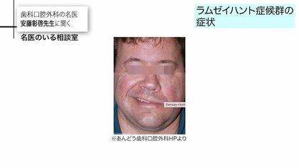 ジャスティン・ビーバー氏の顔面マヒは「ラムゼイハント症候群」…顔面マヒで注意すべき「BE FAST」と早期の治療が必要な理由を専門医が解説