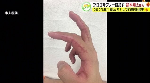 利き手に残る手術跡