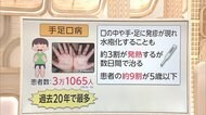 3分でわかるキーワード 過去20年で最多 手足口病