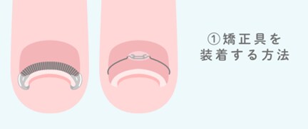 矯正治療の例