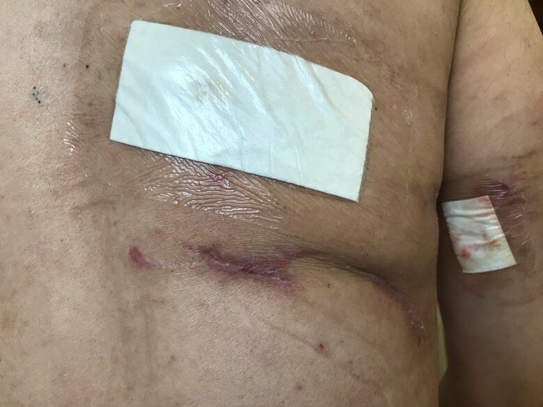 安藤さんの背中と脇の裂傷。入院治療は7カ月に及んだ（本人提供）