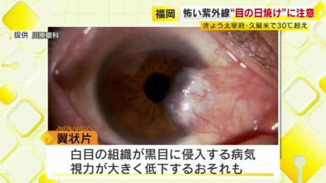 翼状片