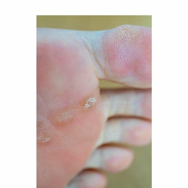 タコとウオノメは同じ皮膚の防御反応（画像はイメージ）