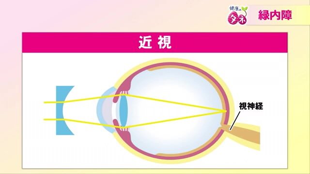 近視の人は眼球の奥行きが伸びる