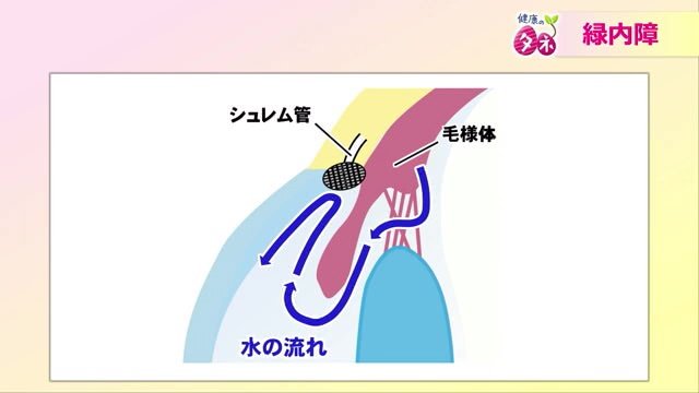 緑内障のメカニズム①