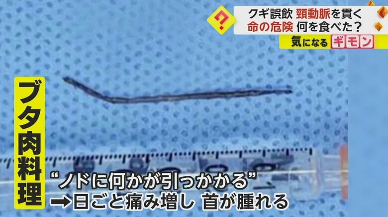 喉に刺さっていた5cmのクギ